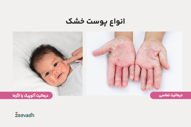 انواع پوست خشک